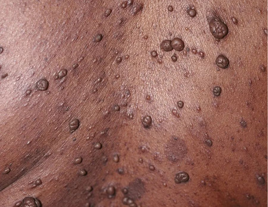 "咖啡牛奶斑" "泡泡宝贝"——这些可能都是神经纤维瘤病的表现